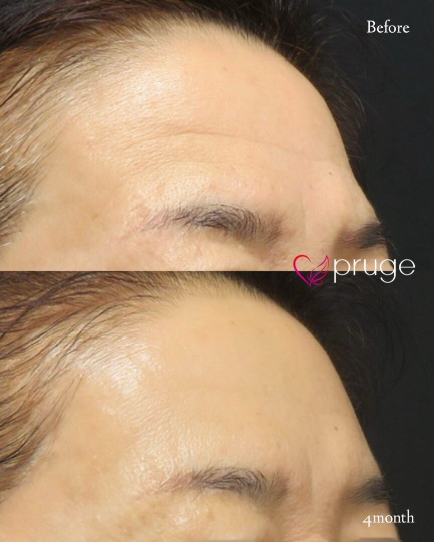 PRP注射（額のシワ）