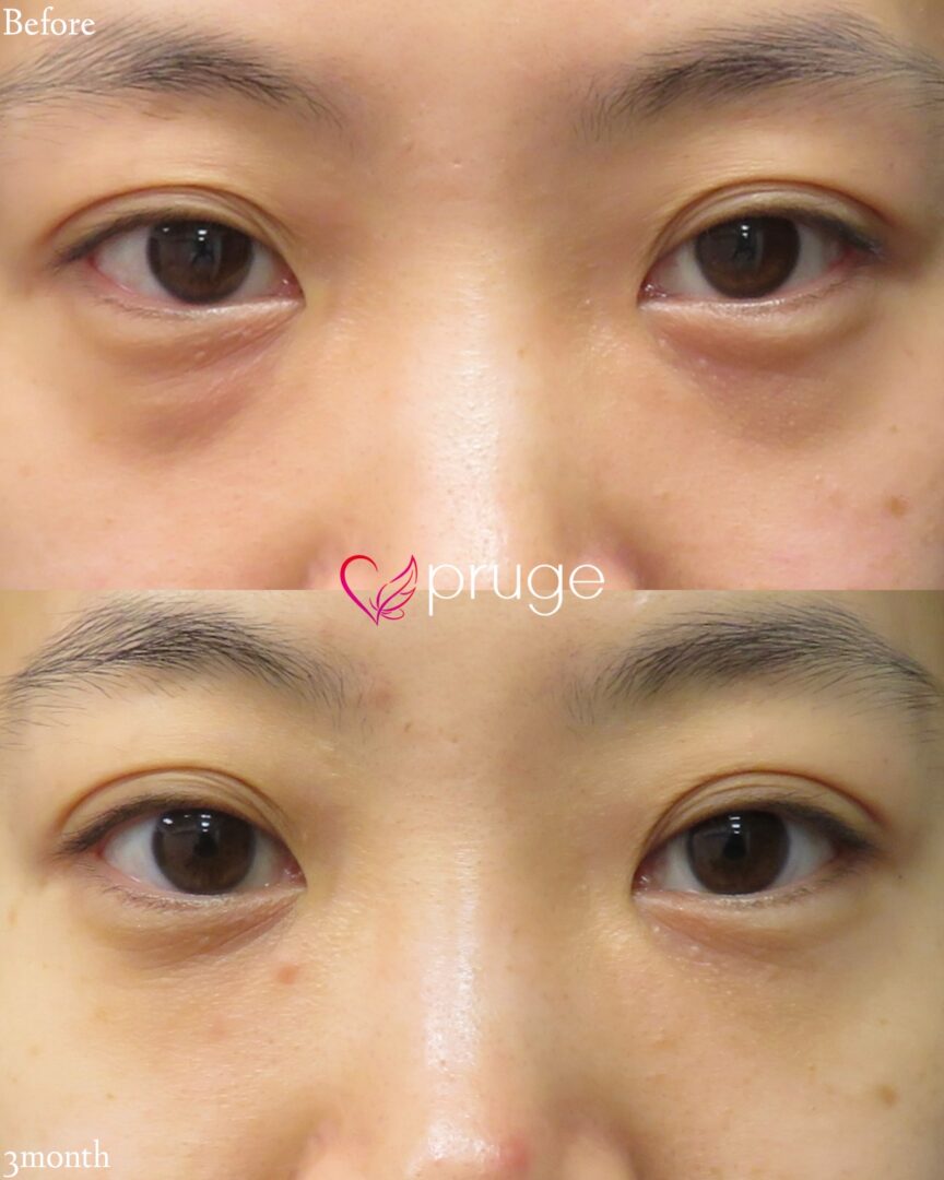 PRP注射（目の下）