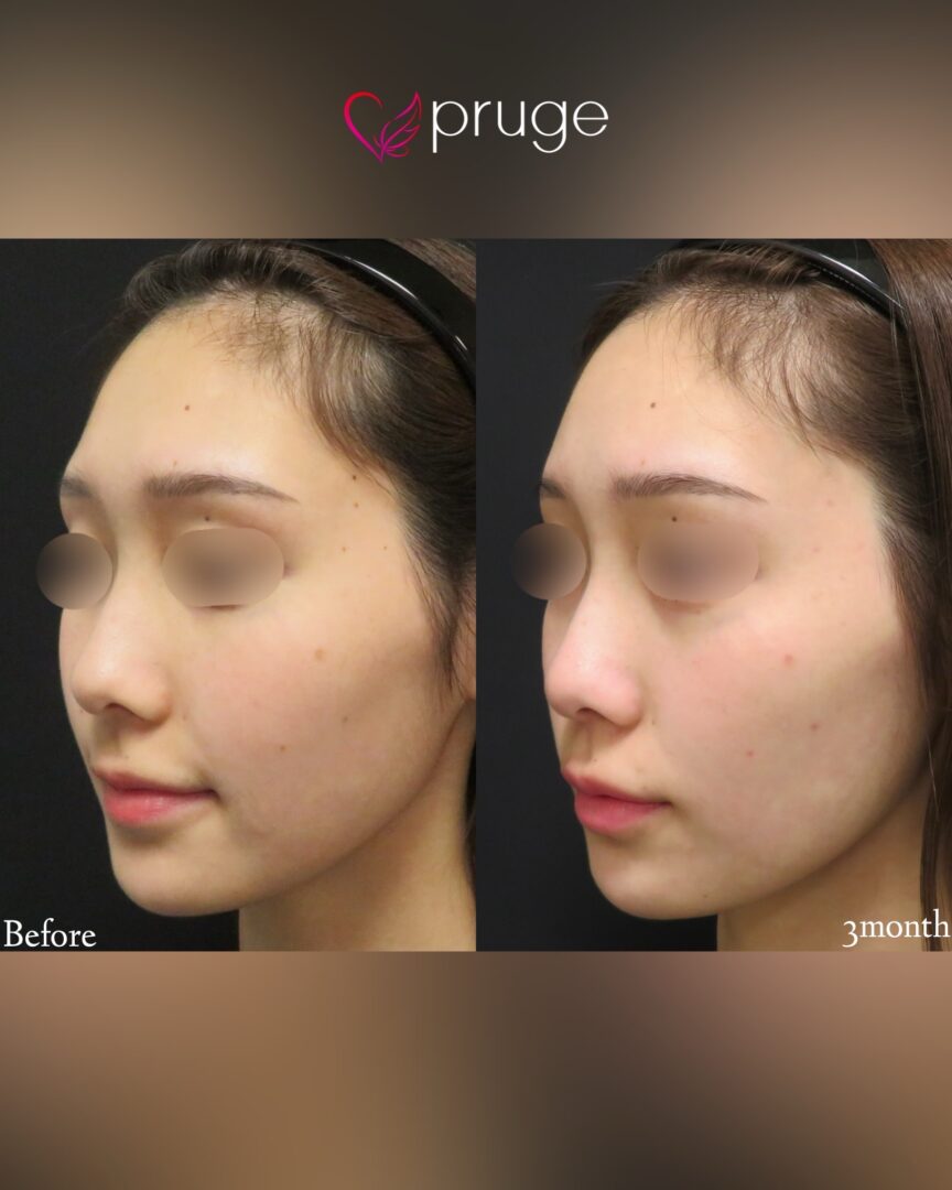 PRP注射(ひたい・こめかみ丸み形成・鼻根・上唇)