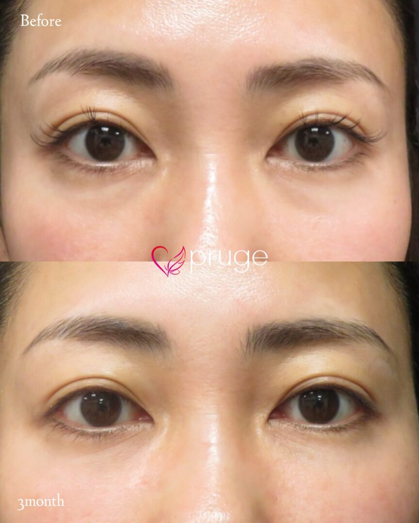 PRP注射(目の下)