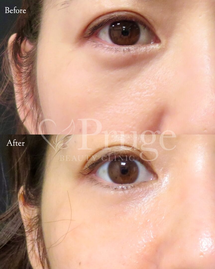 PRP注射(目の下)