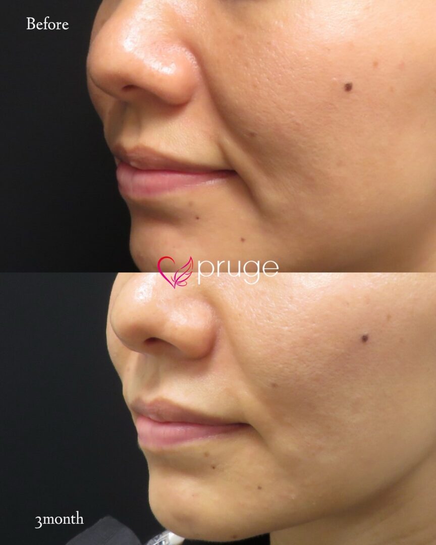 PRP注射(法令線)