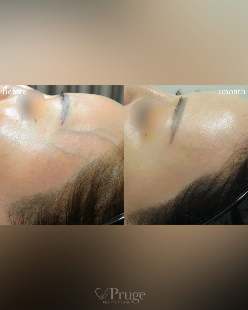 こめかみの血管に対するフェイススクレロセラピー