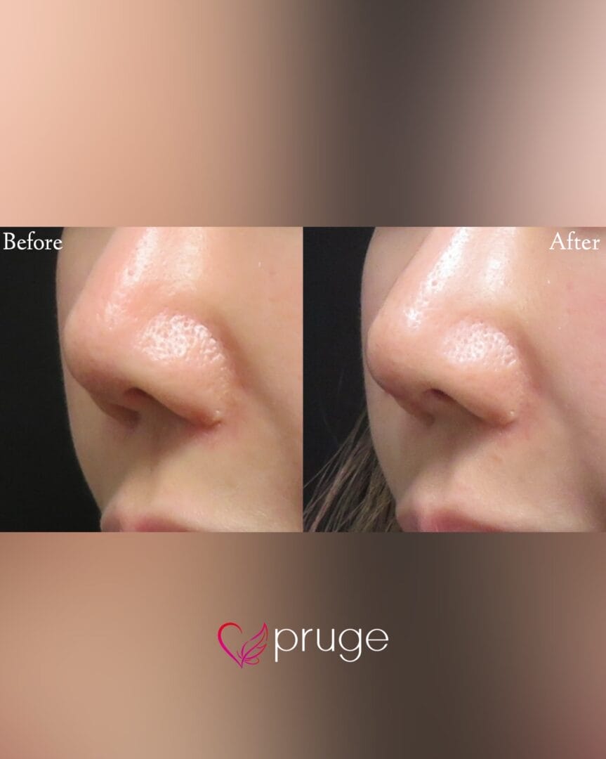 PRP注射(鼻唇角)