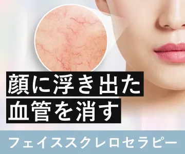 顔に浮き出た血管を消す　フェイススクレロセラピー