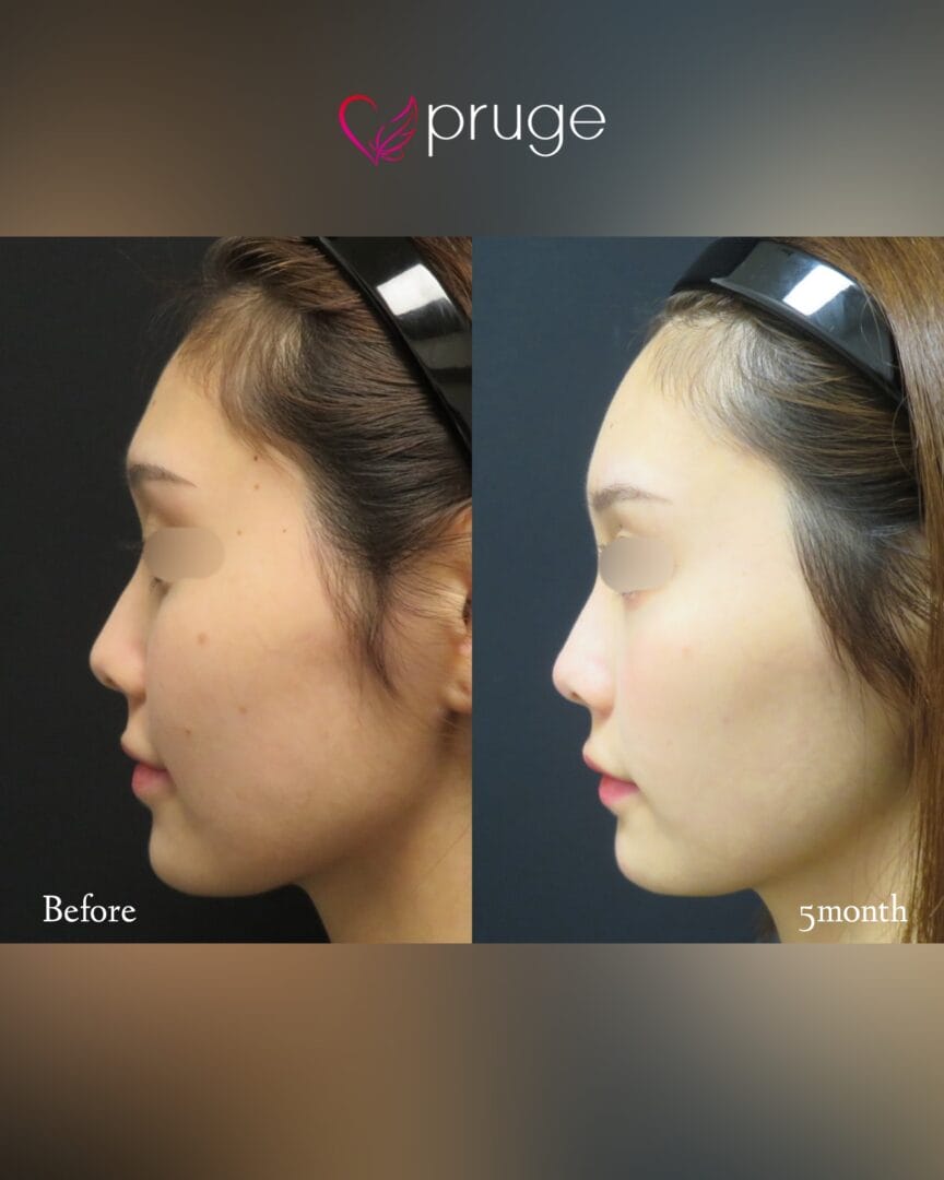 PRP注射(ひたいこめかみ丸み形成)