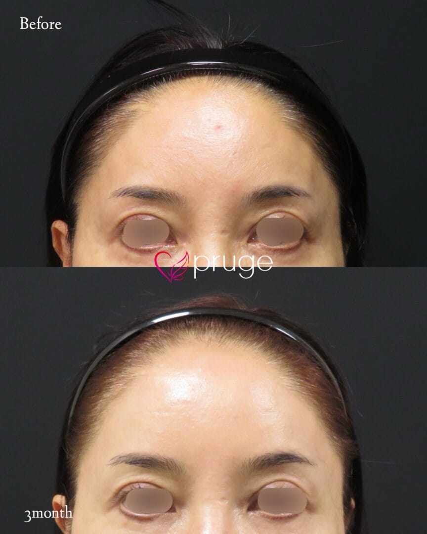 PRP注射（こめかみ凹み）