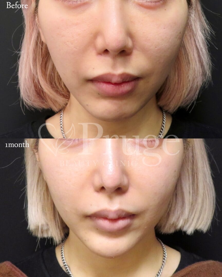 pスリム注射(フェイスライン)