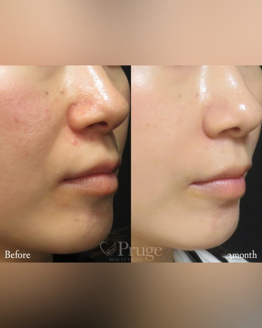 PRP注射(鼻翼基部)