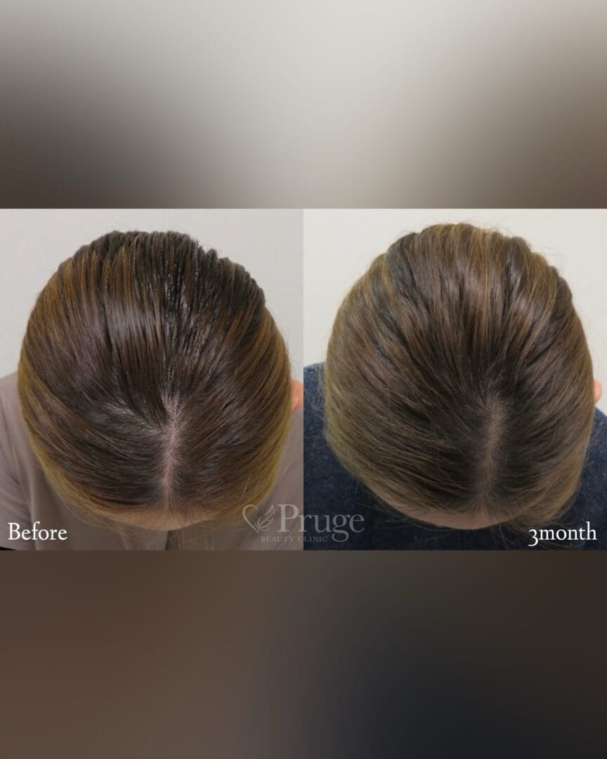 PRP注射による後頭部形成術