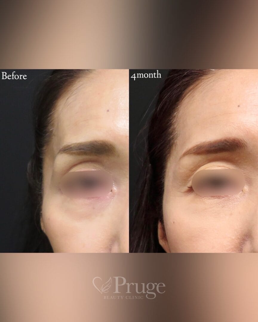 PRP注射(こめかみ凹み)