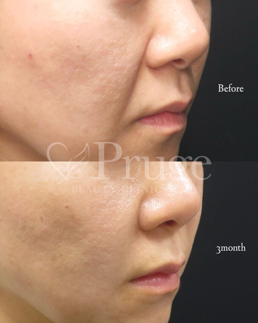 PRP注射(法令線)