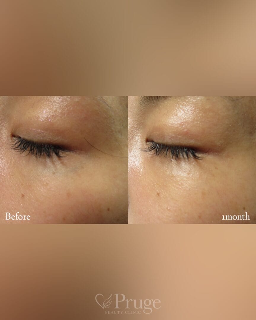 目尻の血管に対するフェイススクレロセラピー