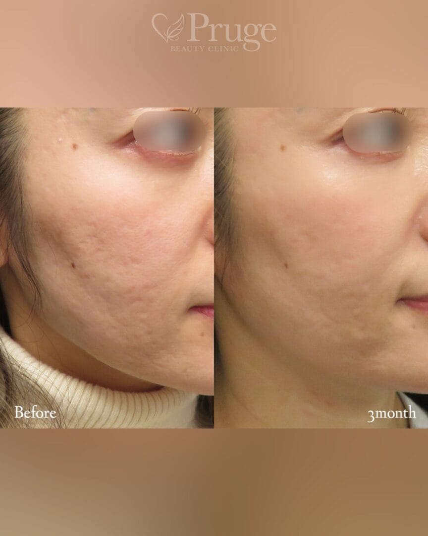 PRPサブシジョン法(ホホ)