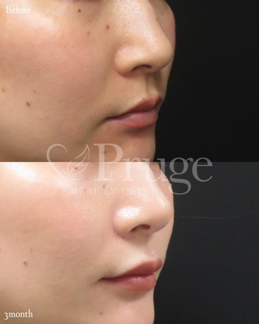 PRP注射(法令線)