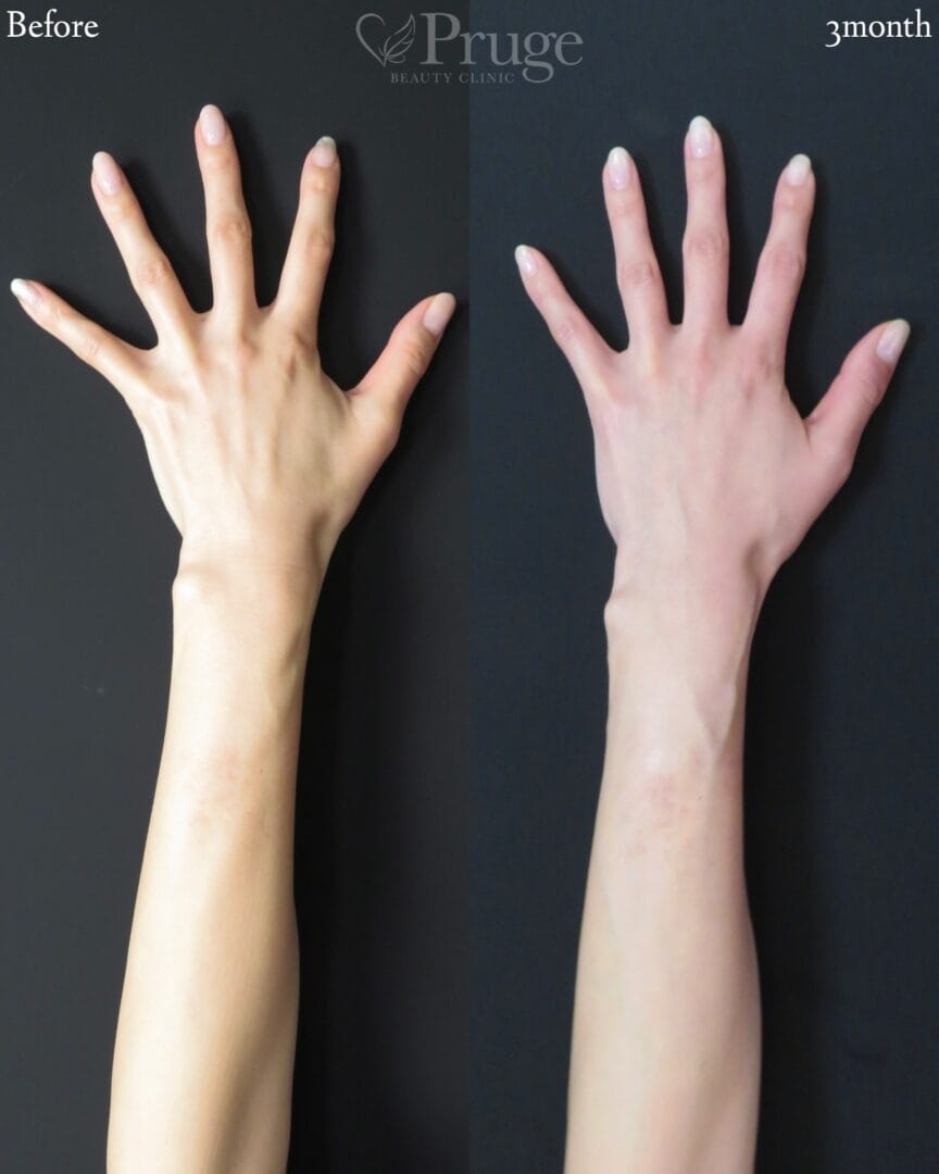 PRP注射(手の甲)