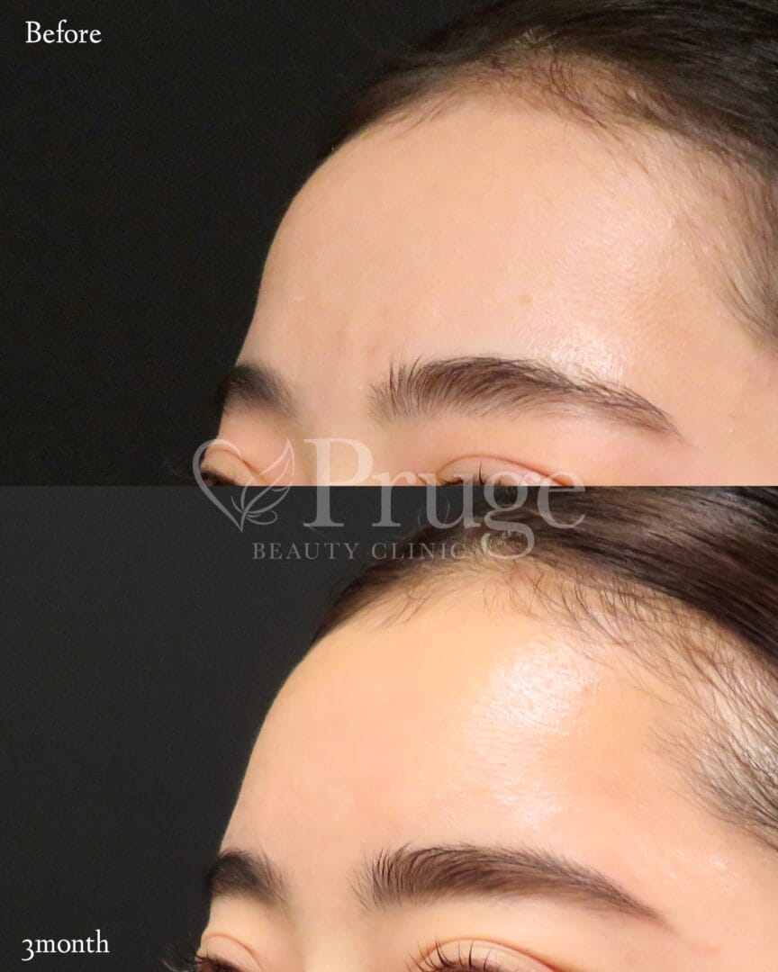 PRP注射(ひたい・こめかみ丸み形成)