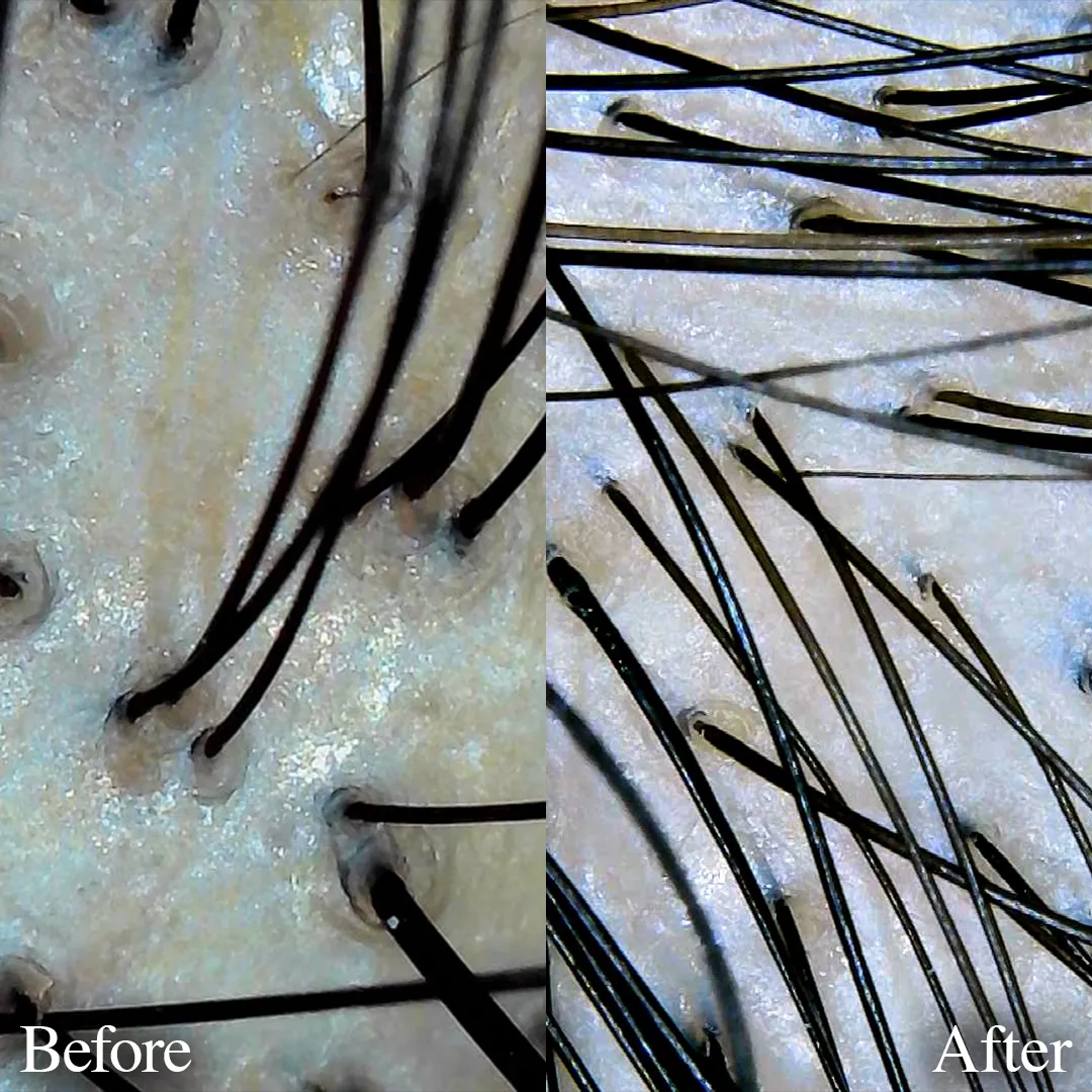 p-スカルプ：頭皮スコープ