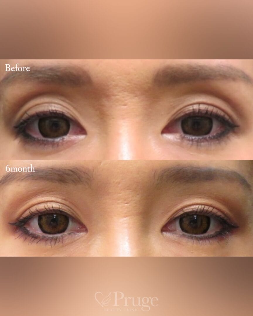 PRP注射(目の上)