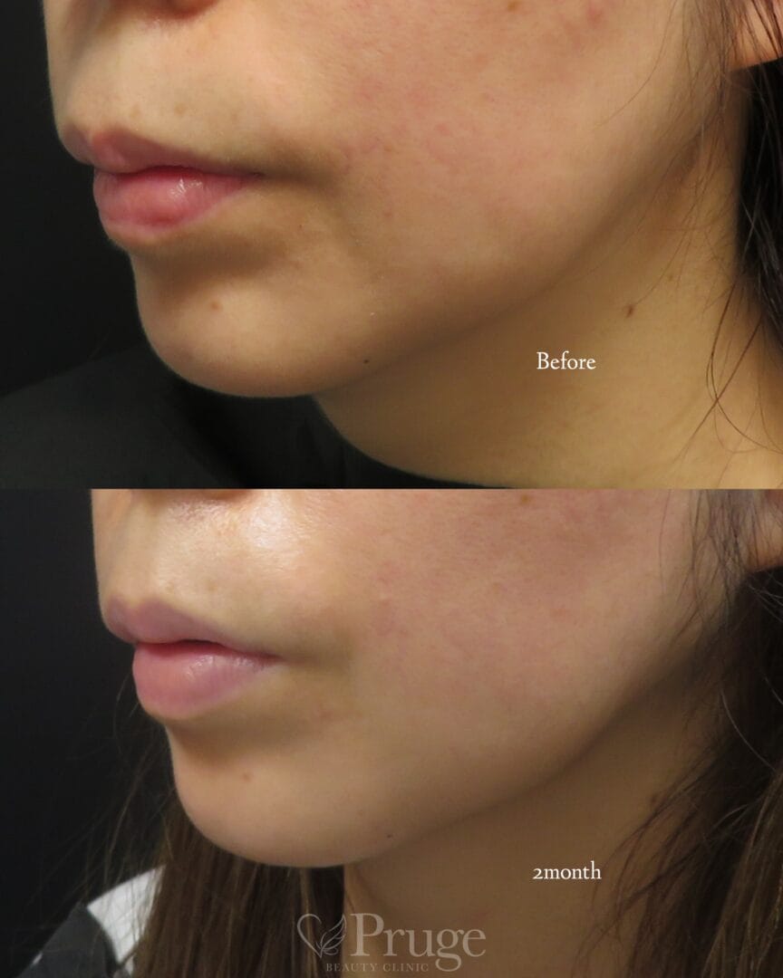 ｐスリム注射(フェイスライン)