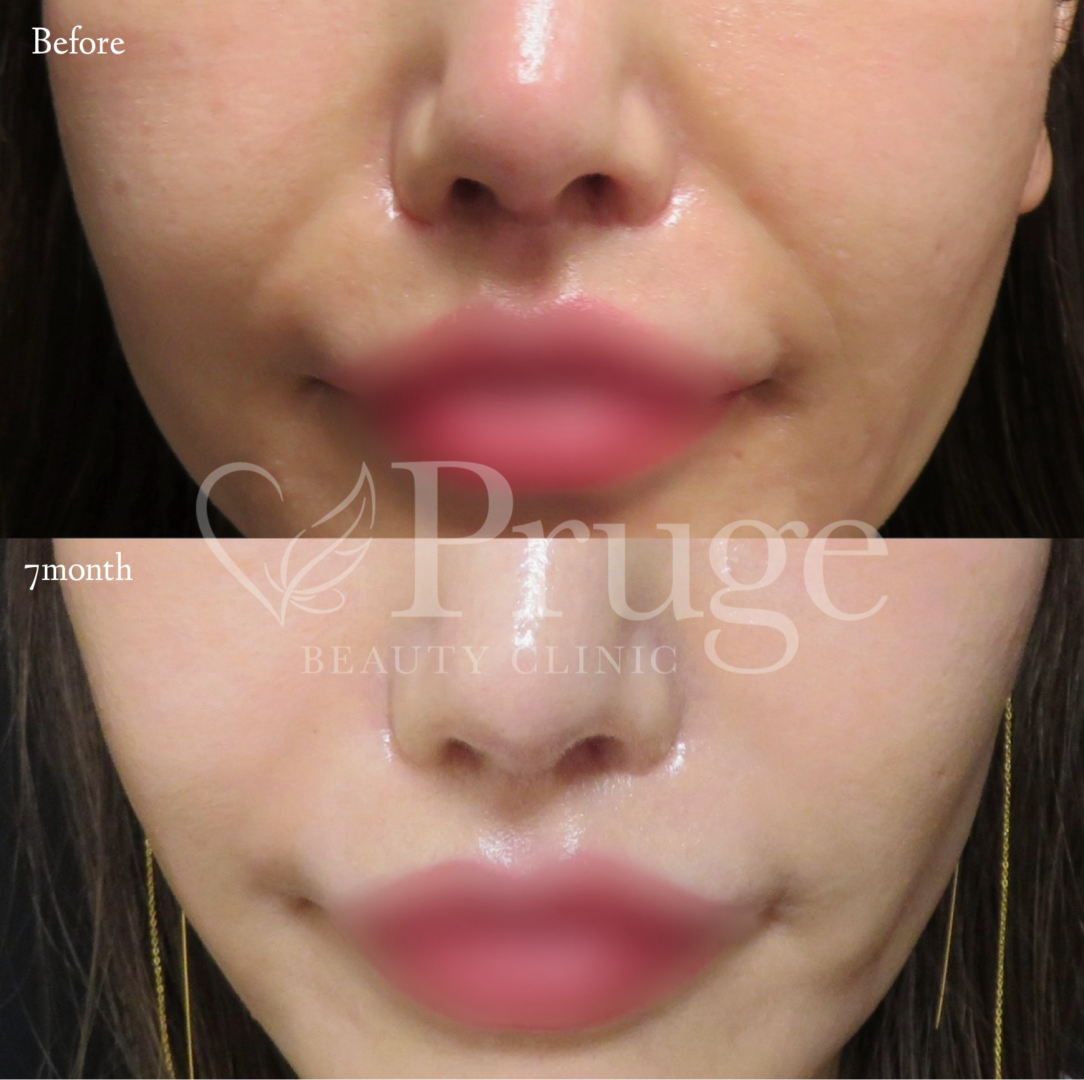 PRP注射(法令線)