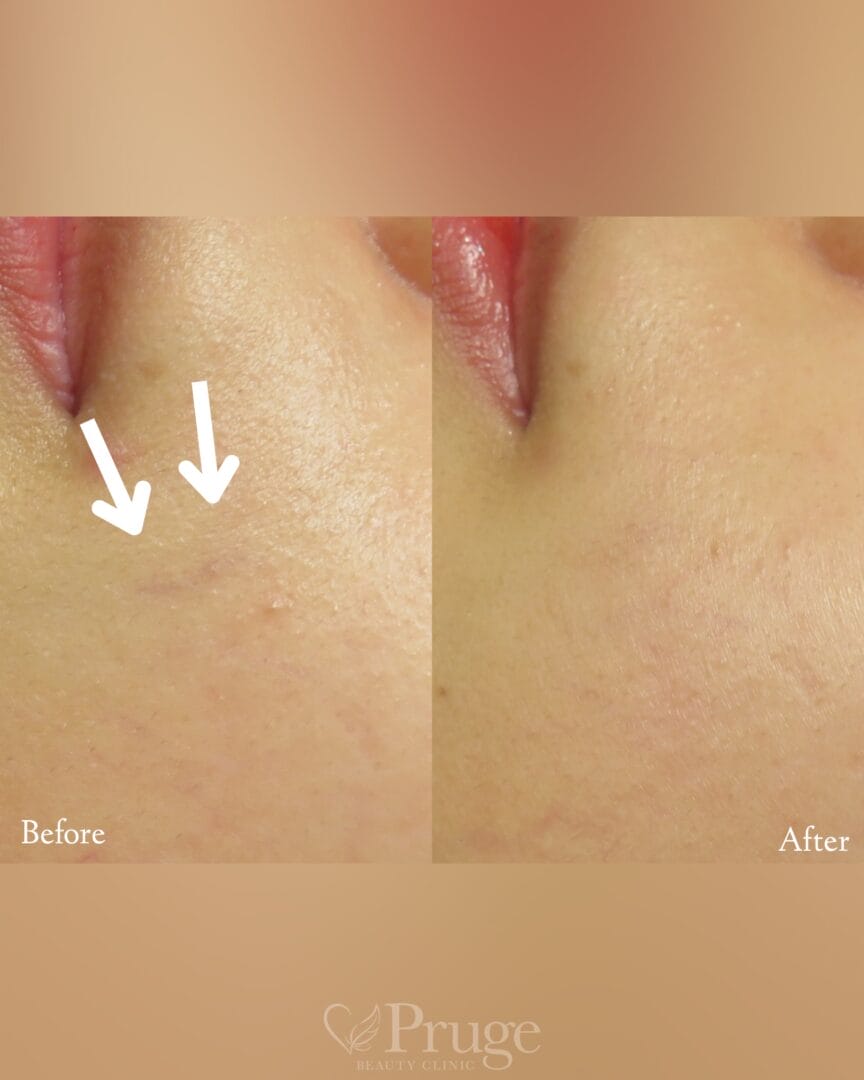 口横の血管に対するフェイススクレロセラピー