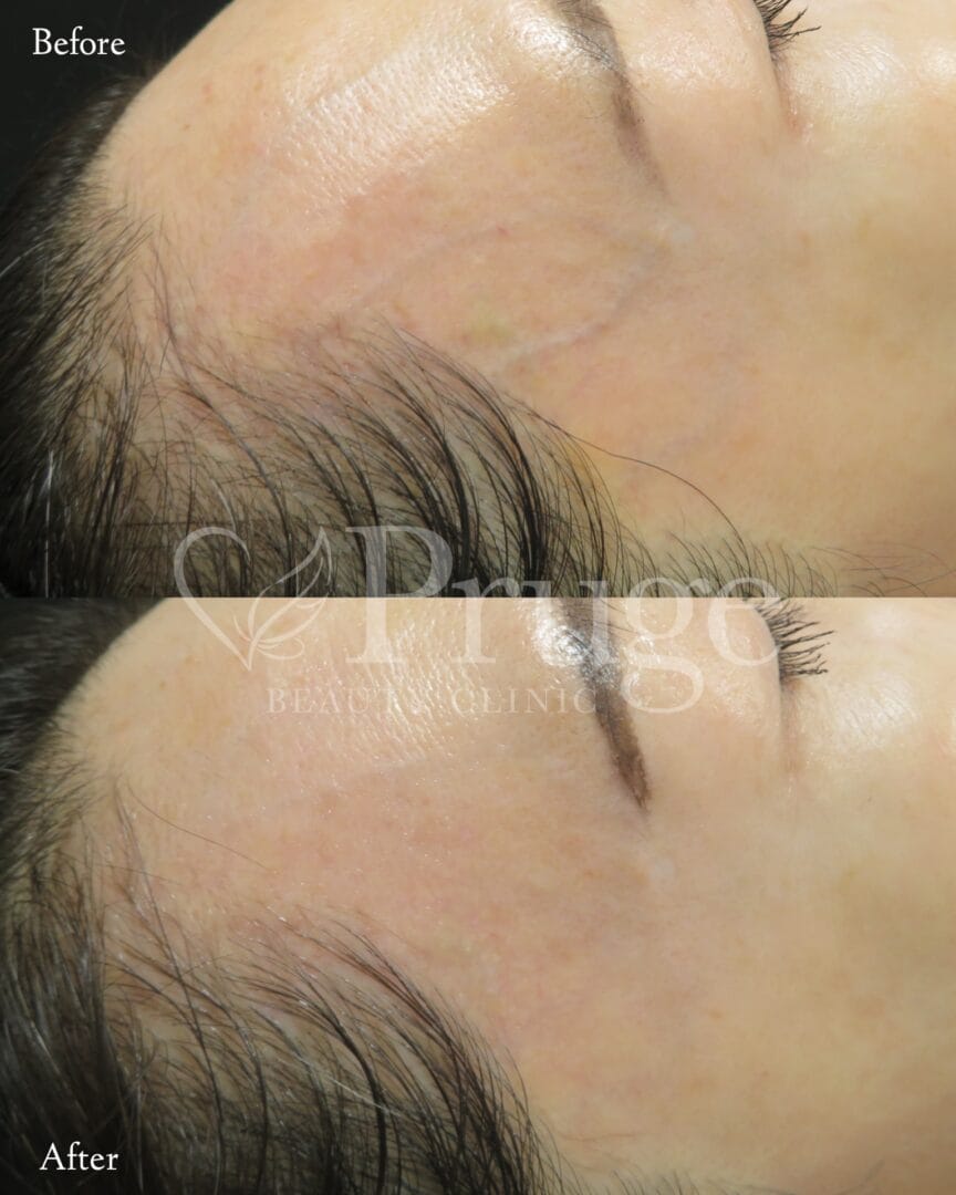 こめかみの血管に対するフェイススクレロセラピーの症例写真