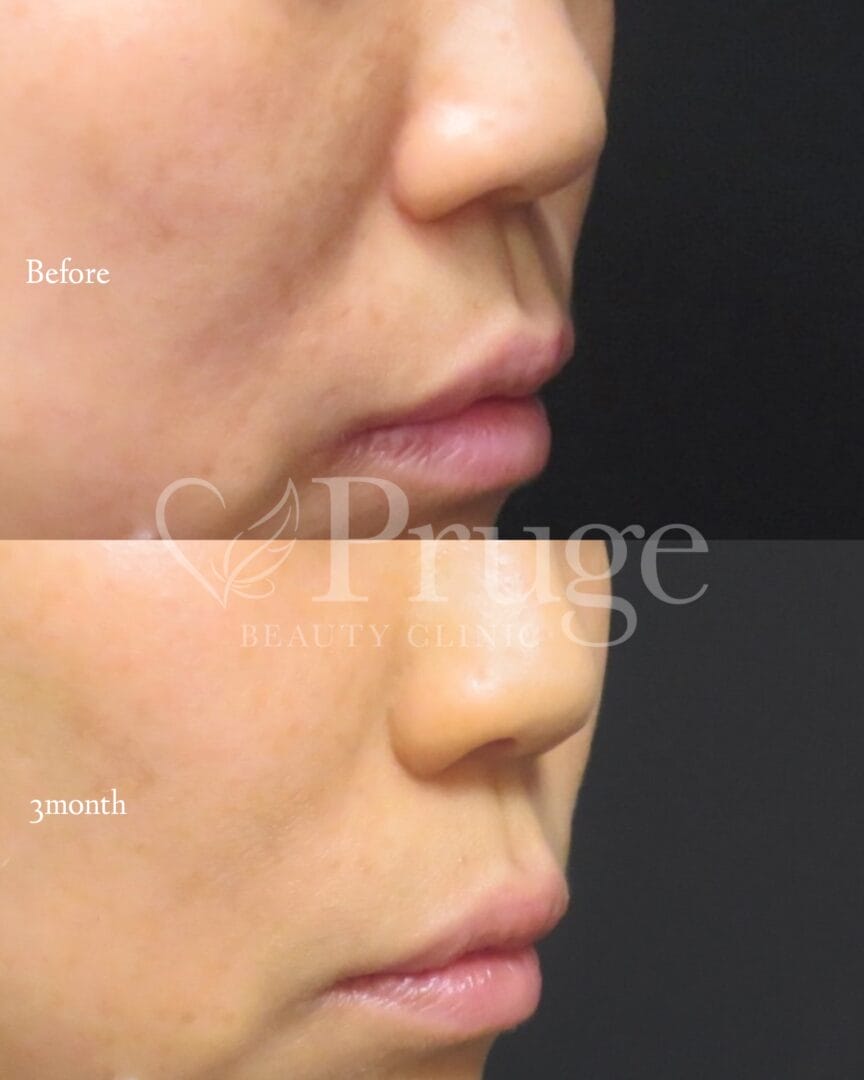 PRP注射(ほうれい線)の症例写真