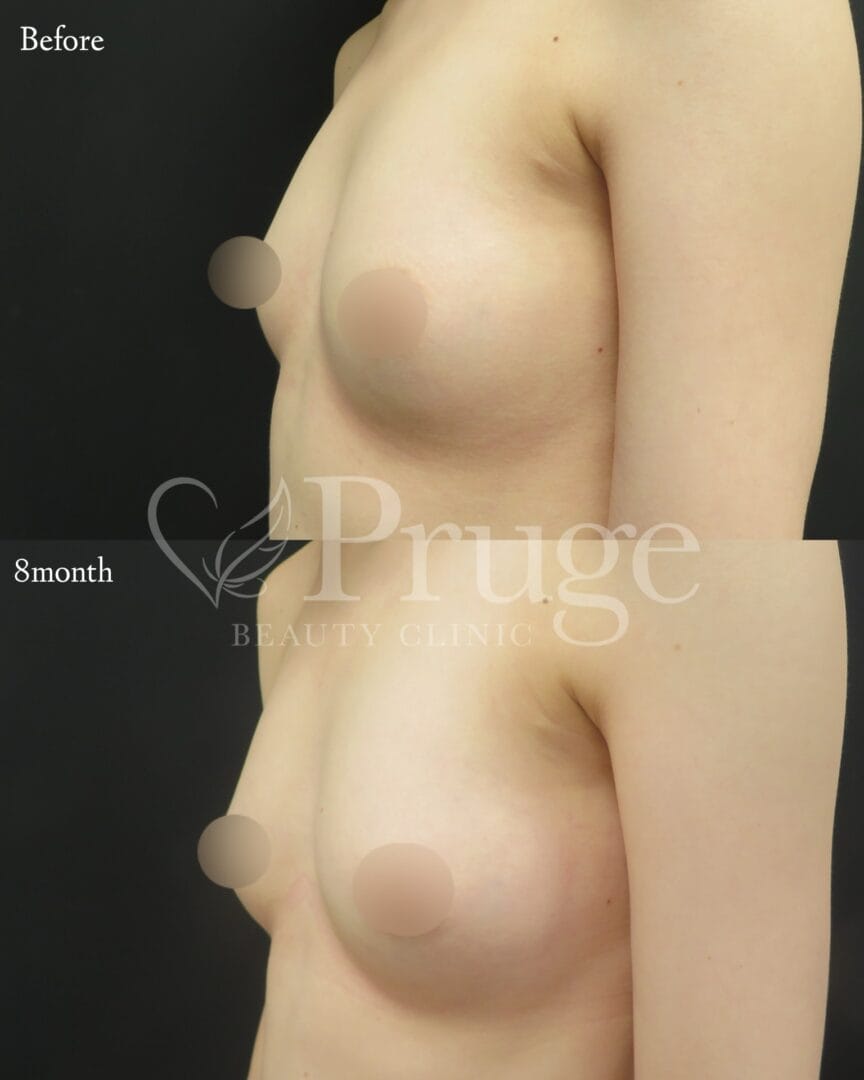 PRP注射によるバストアップの症例写真