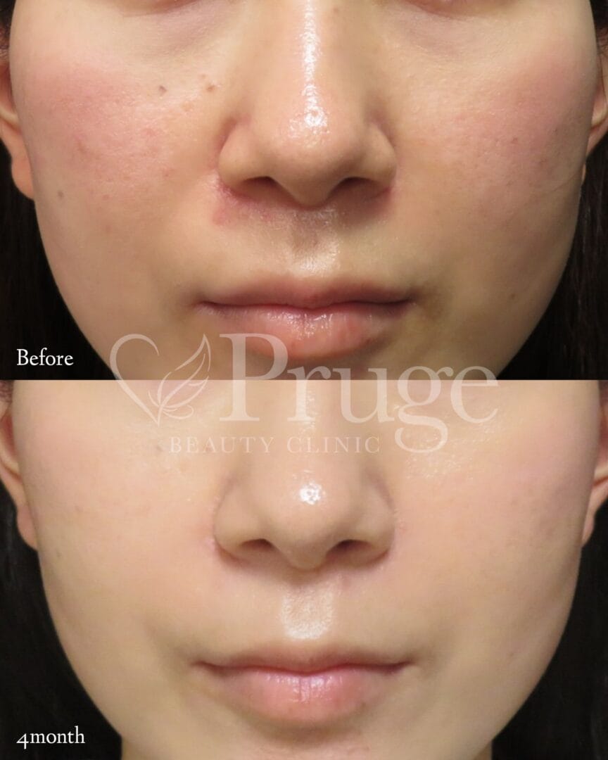 PRP注射(鼻翼基部)の症例写真