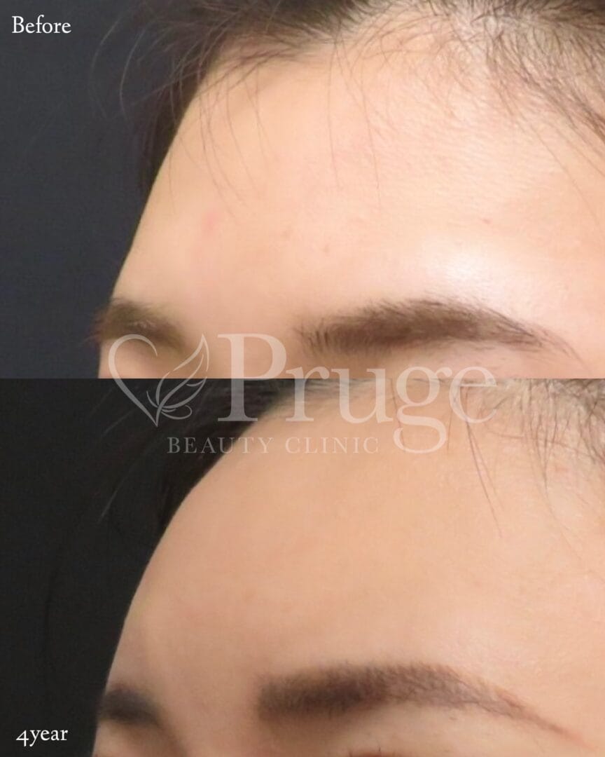 PRP注射(ひたい・こめかみ丸み形成)の症例写真