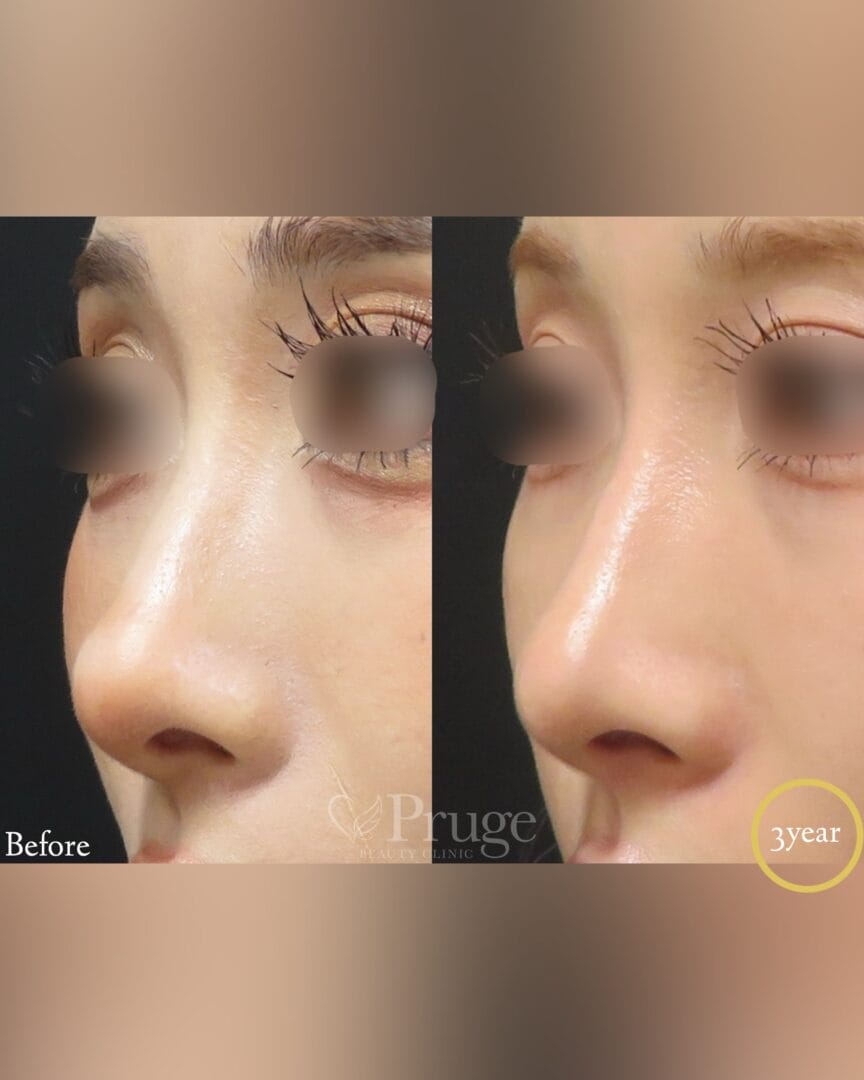 PRP注射(鼻根・鼻孔・鼻尖)の症例写真