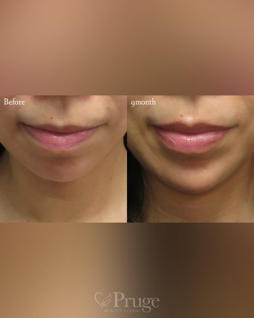 PRP注射（顎）の症例写真