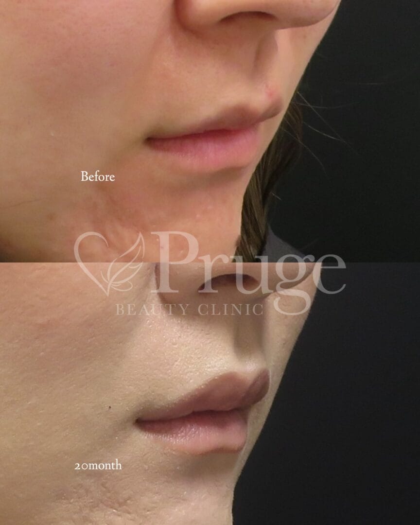 PRP注射（唇）の症例写真