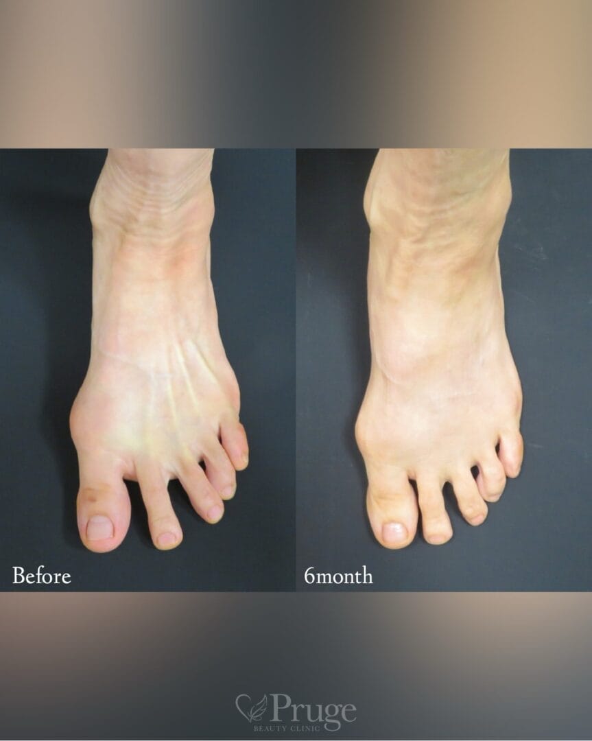 PRP注射（足の甲）の症例写真