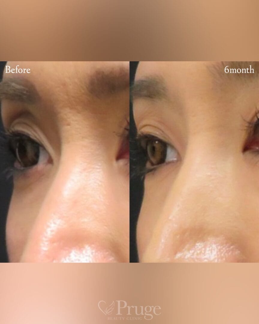 PRP注射(鼻根)の症例写真