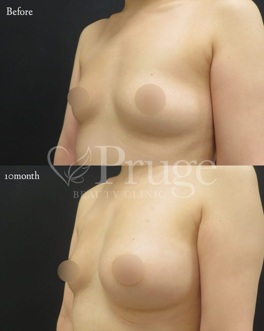 PRP注射によるバストアップの症例写真