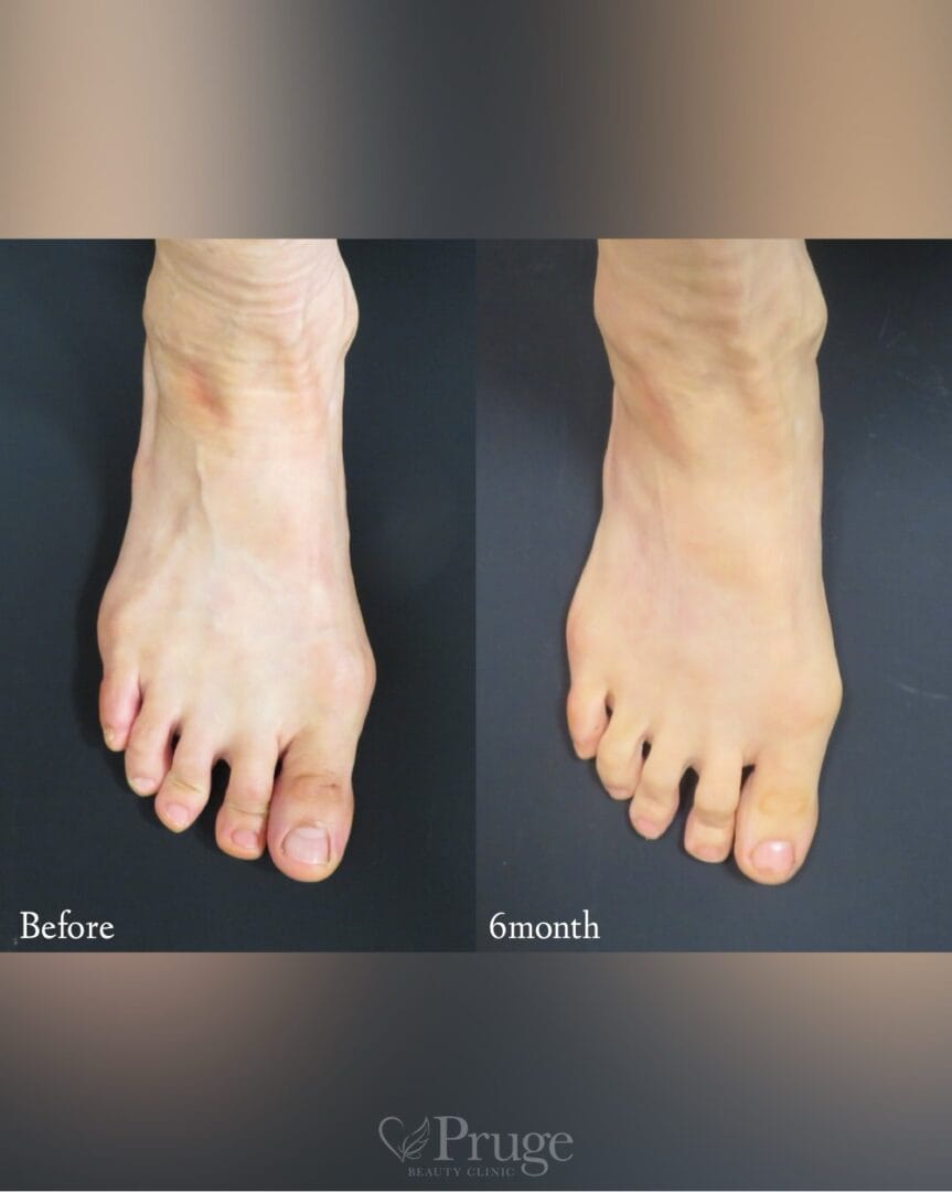 PRP注射（足の甲）の症例写真
