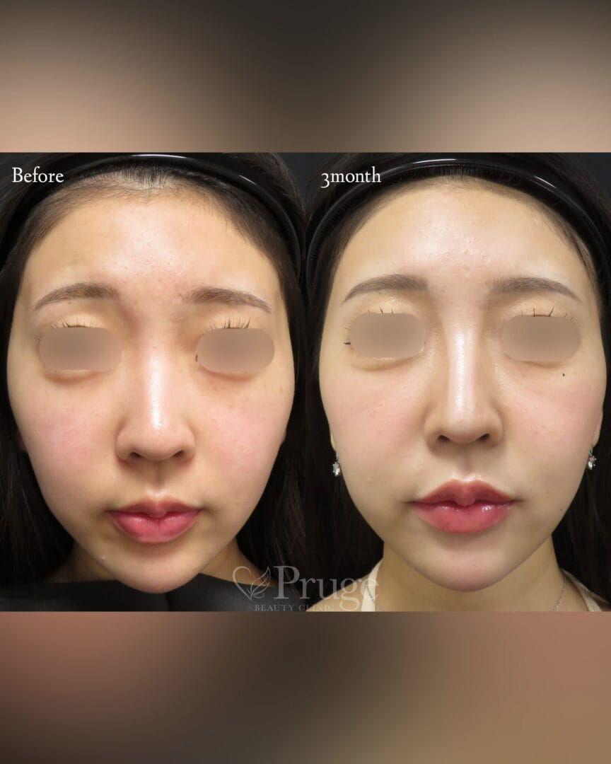 PRP注射(ひたい・こめかみ丸み形成)の症例写真