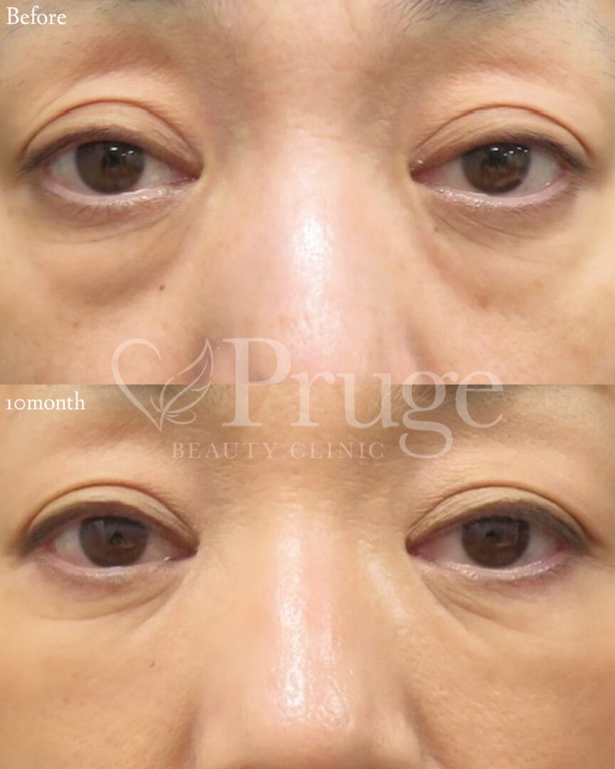 PRP-MI脱脂術の症例写真