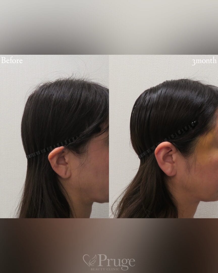 PRP注射(後頭部形成術)の症例写真