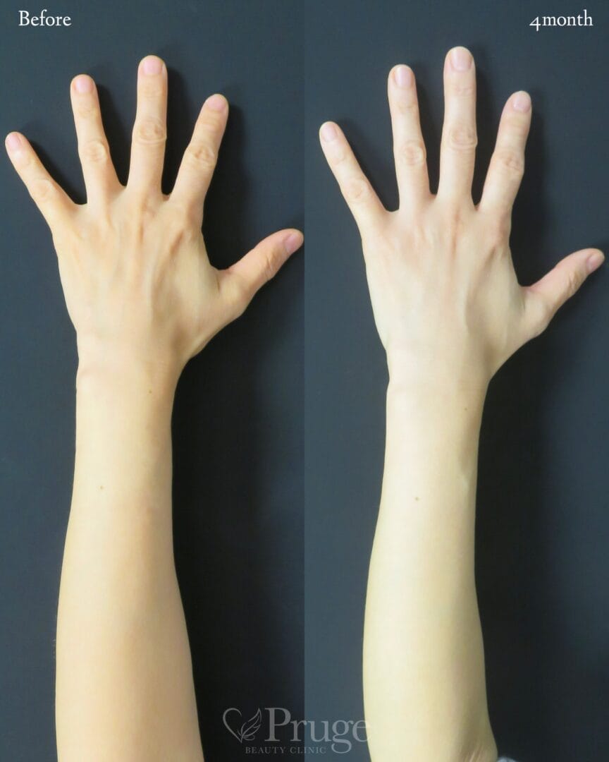 PRP注射(手の甲・腕)の症例写真