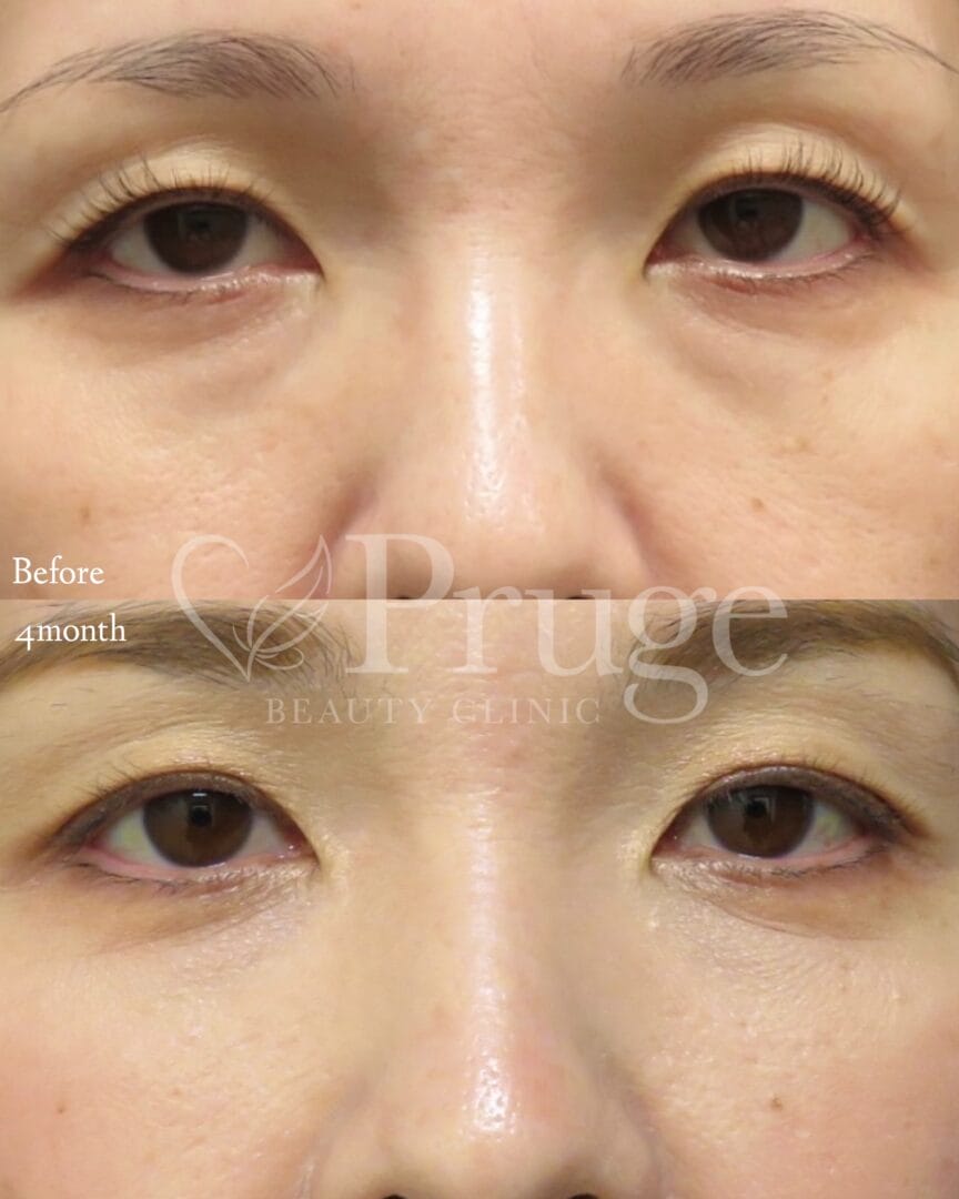 PRP注射(目の下)の症例写真