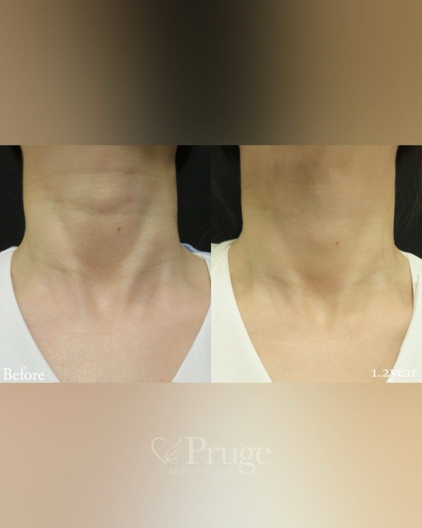 PRP注射(首)の症例写真