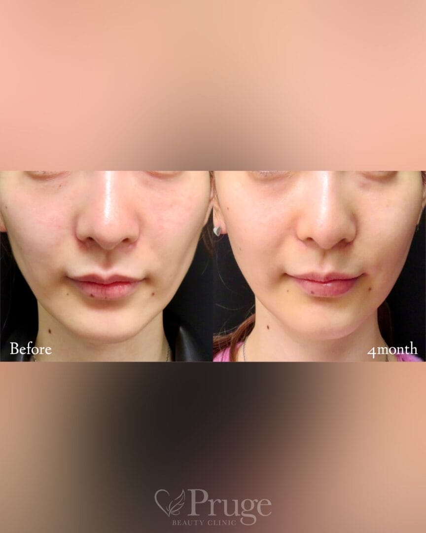 PRP注射(ホホ)の症例写真