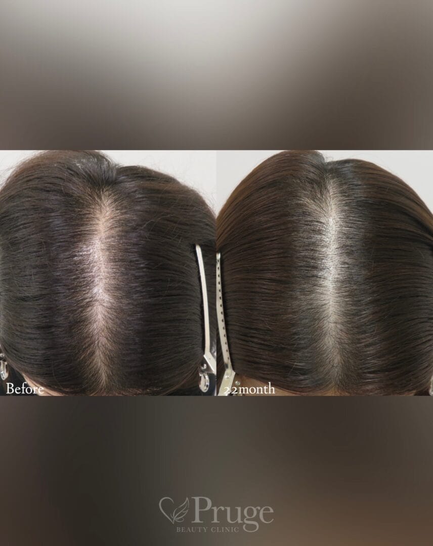 p-Scalpの症例写真