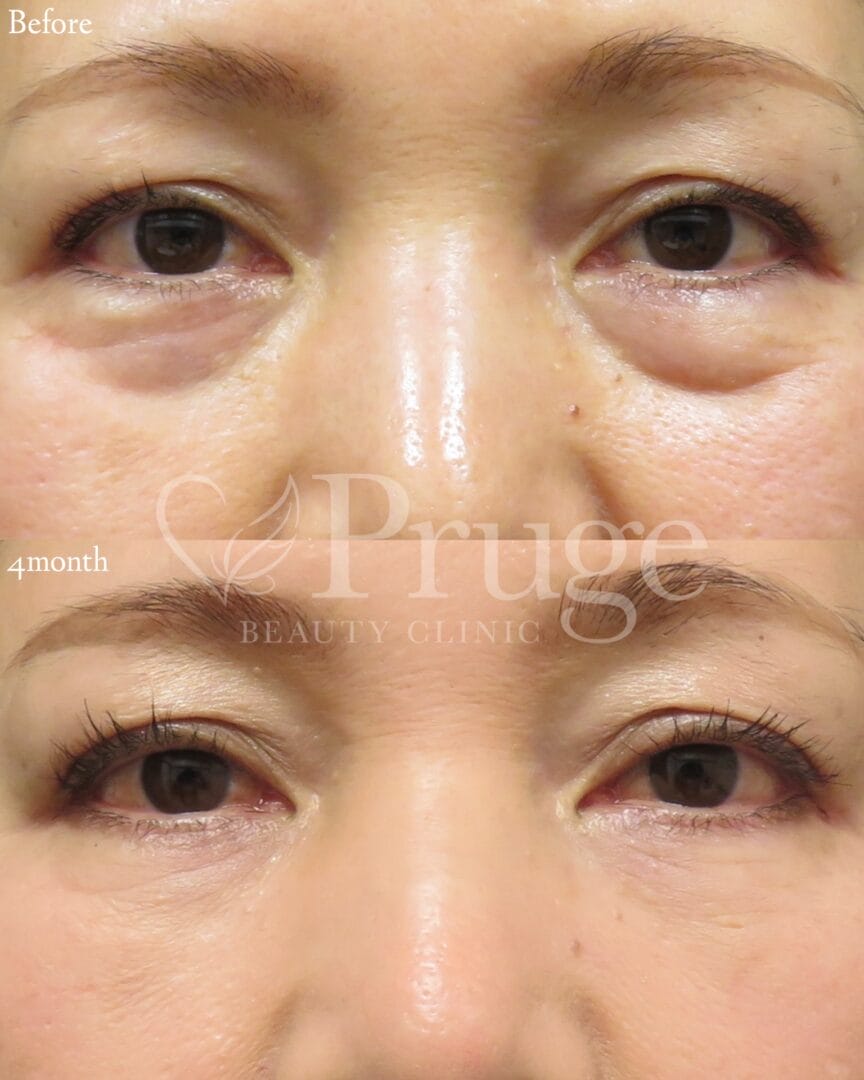 PRP注射(目の下)