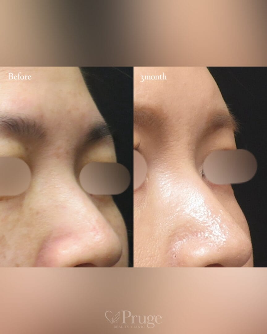 PRP注射（鼻根）