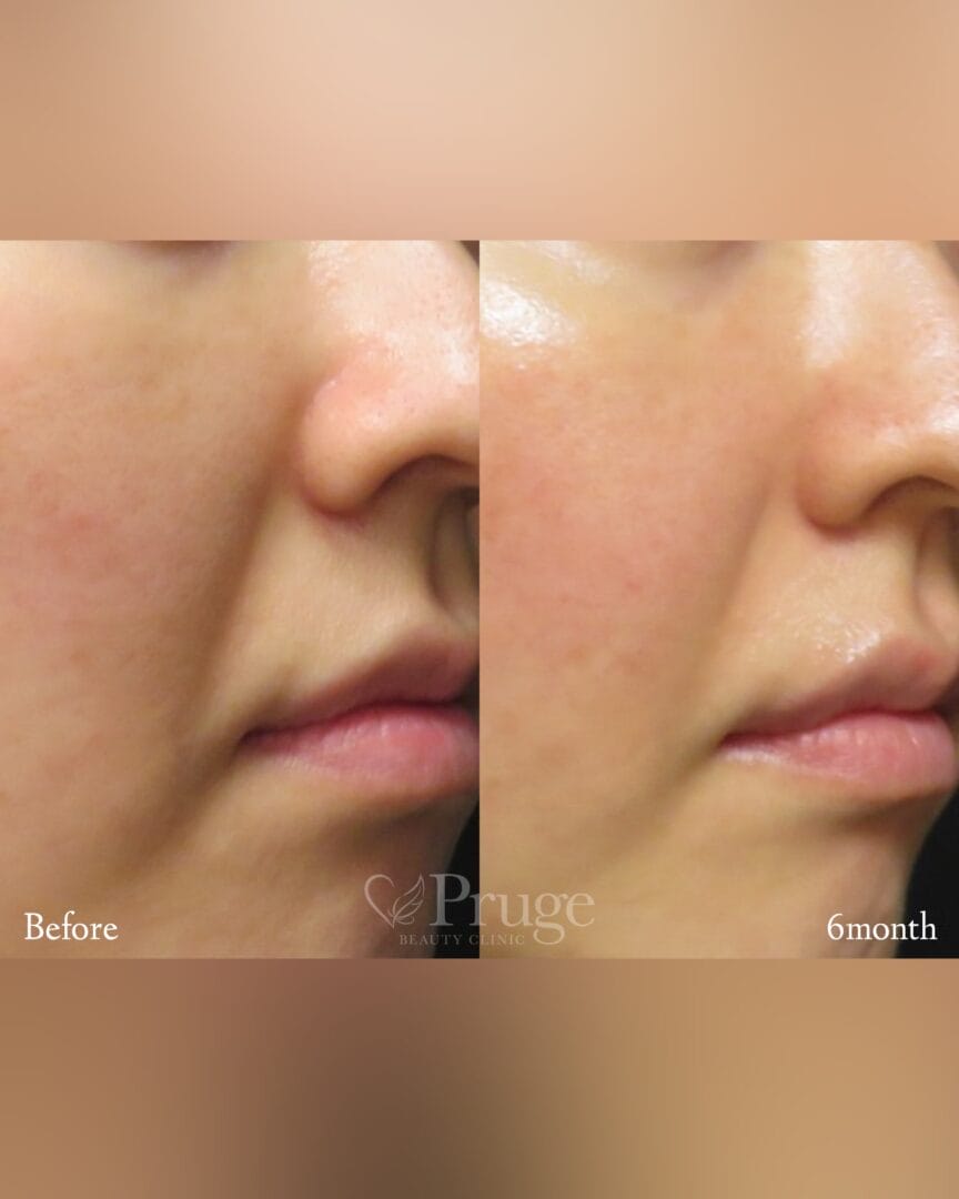 PRP注射(ほうれい線)の症例写真