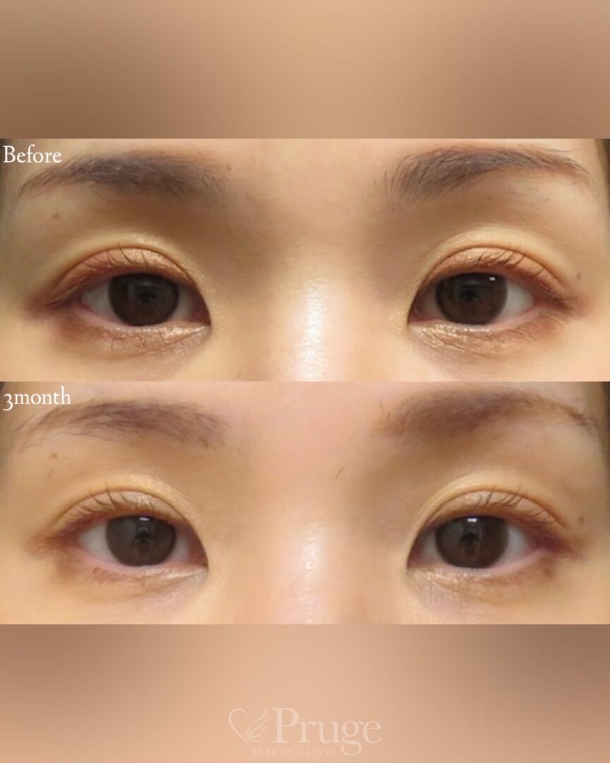 PRP注射(目の上)